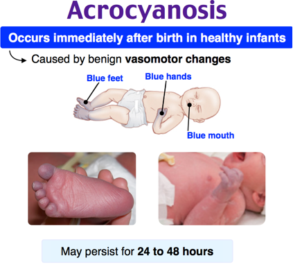 Acrocyanosis - normal peripheral cyanosis in a neonate