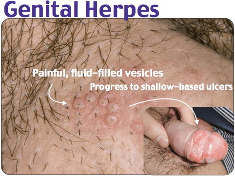 Genital herpes (Herpes simplex II)