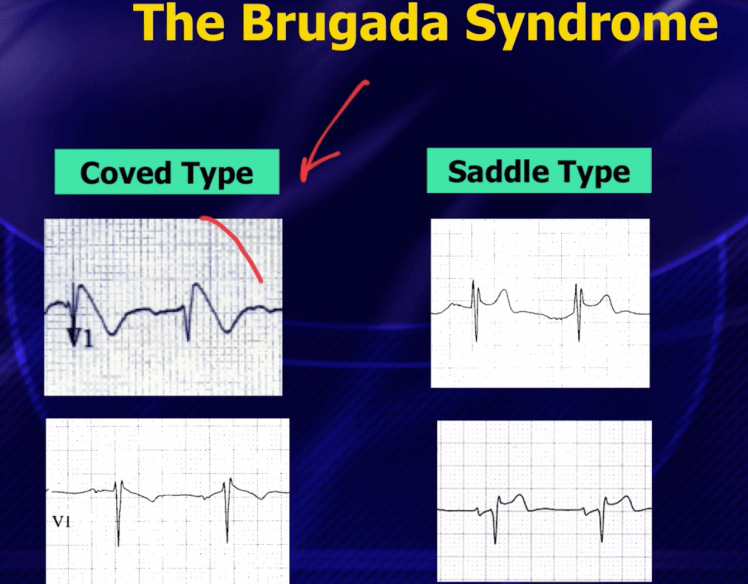 Brugada ECG patterns