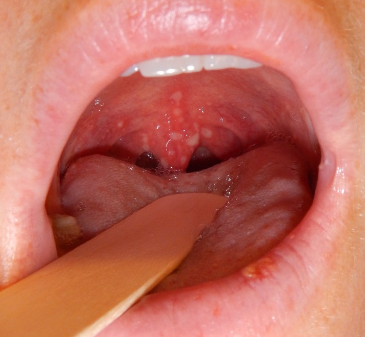 Herpangina findings