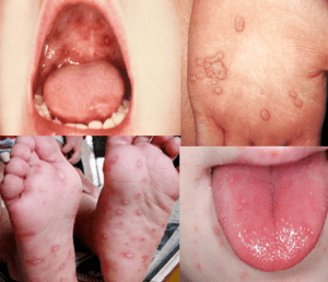 Hand-foot-mouth disease findings