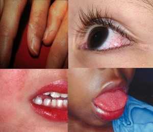 Kawasaki disease clinical features