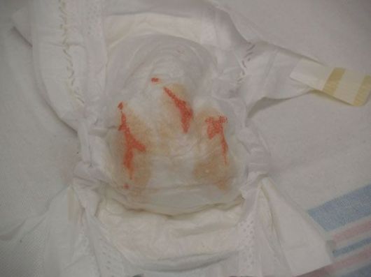 Normal urate crystals (brick dust) on a newborn diaper