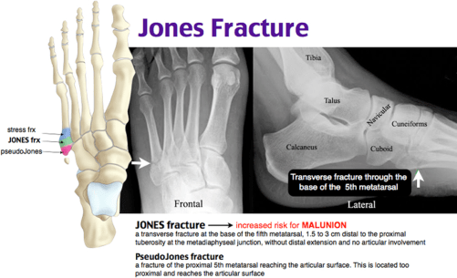 5th metatarsal fracture zones