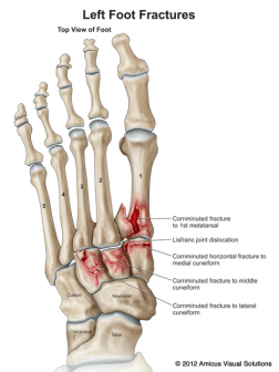 Lisfranc fracture illustration