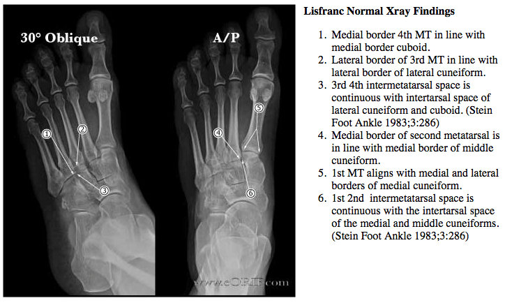 Lisfranc normal alignment