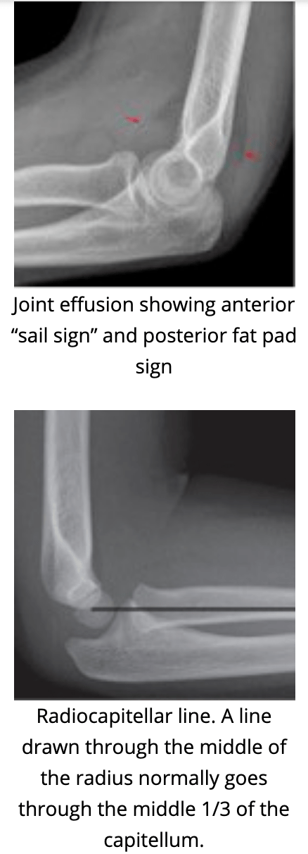 Radial head fracture X-ray