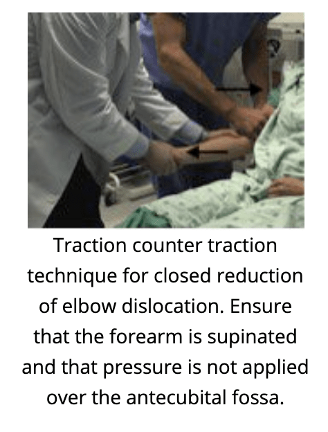 Elbow reduction technique