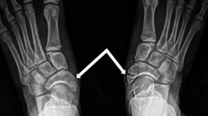 Navicular fracture
