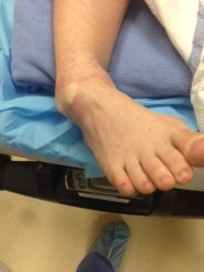 Subtalar dislocation