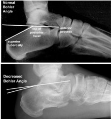 Bohler's angle
